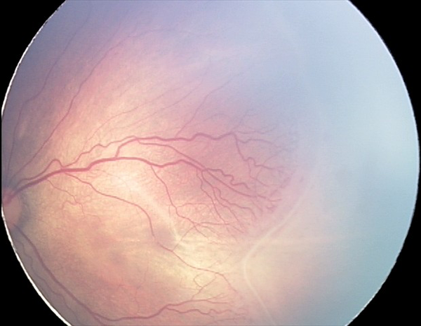 Retinopathy of Prematurity ROP